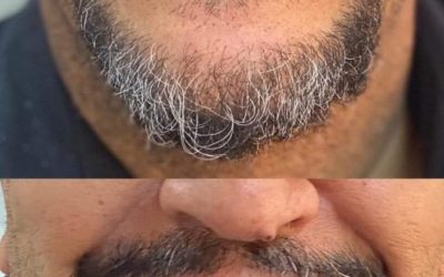 تسليم أكثر من 250 طاقمًا صناعيًا كاملاً لزوار قسم الاستعاضة الصناعية المتحركة