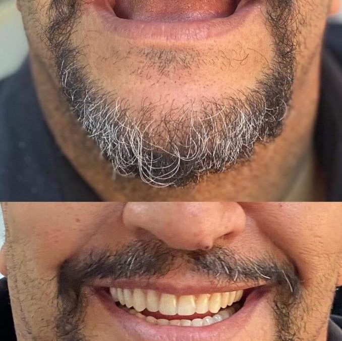تسليم أكثر من 250 طاقمًا صناعيًا كاملاً لزوار قسم الاستعاضة الصناعية المتحركة